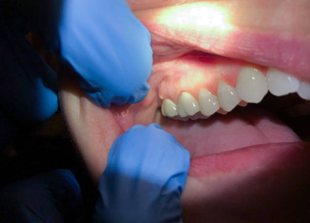 Best Emergency Root Canal Treatment in Lochearn, MD