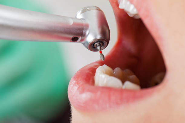 Best Emergency Dental Care for Abscessed Tooth in Lochearn, MD